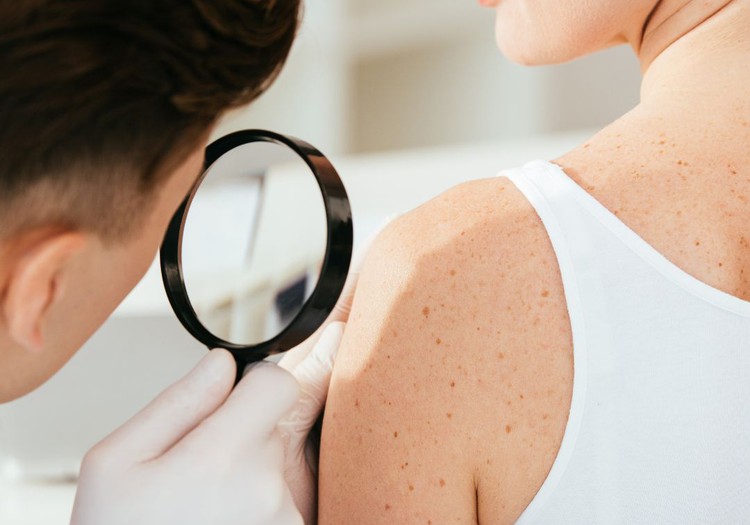 Melanoma – kā sevi pasargāt?