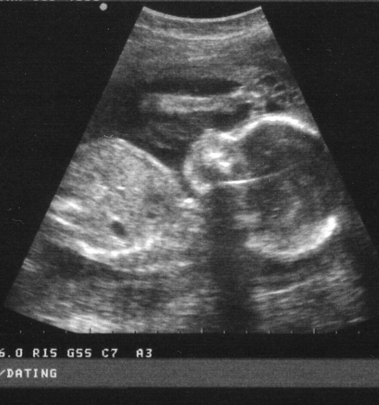 Nabassaite ap kaklu. Vai mazulis var piedzimt pats?