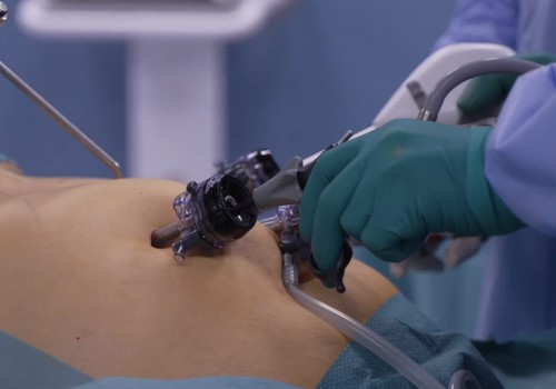 VIDEO: Kā notiek bariatrijas operācija?