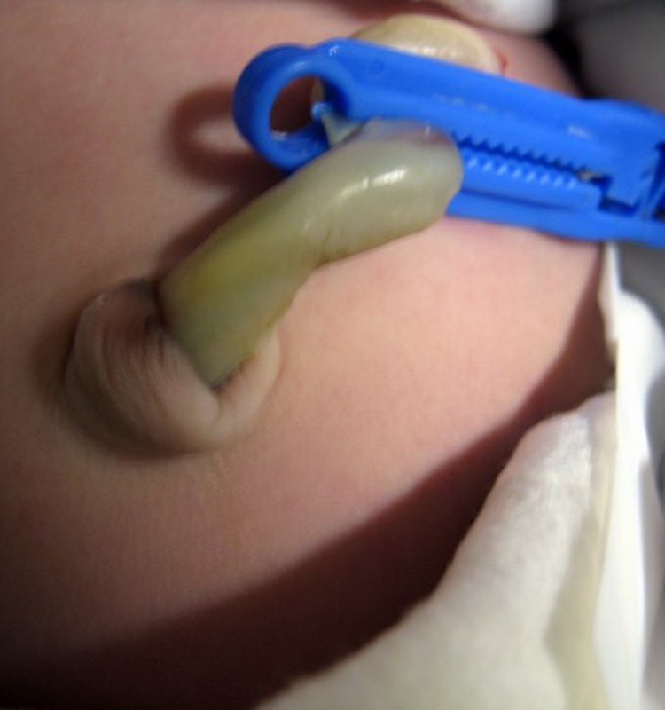 Vai pirms dzemdībām var noteikt nabassaites garumu?