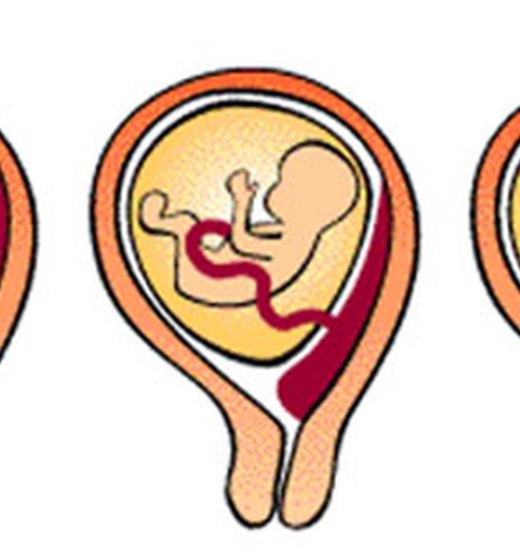 Priekšguļoša placenta: kas tā ir?