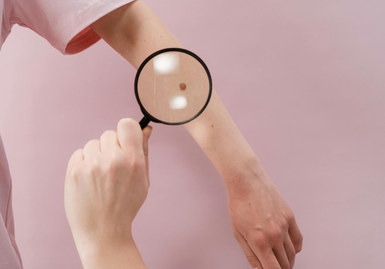 Ādas vēzis: pazīmes, profilakse un ārstēšana – dermatologa padomi