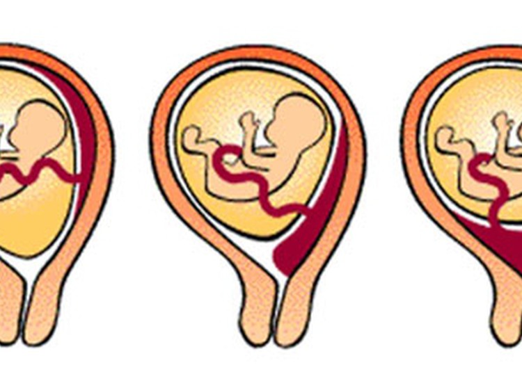 Priekšguļoša placenta: kas tā ir?