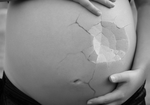 Ārpusdzemdes grūtniecība jeb kāpēc mans bērniņš nepiedzima