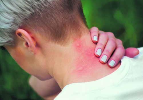 VESELĪBA: Ja ir alerģija pret kukaiņu kodumiem