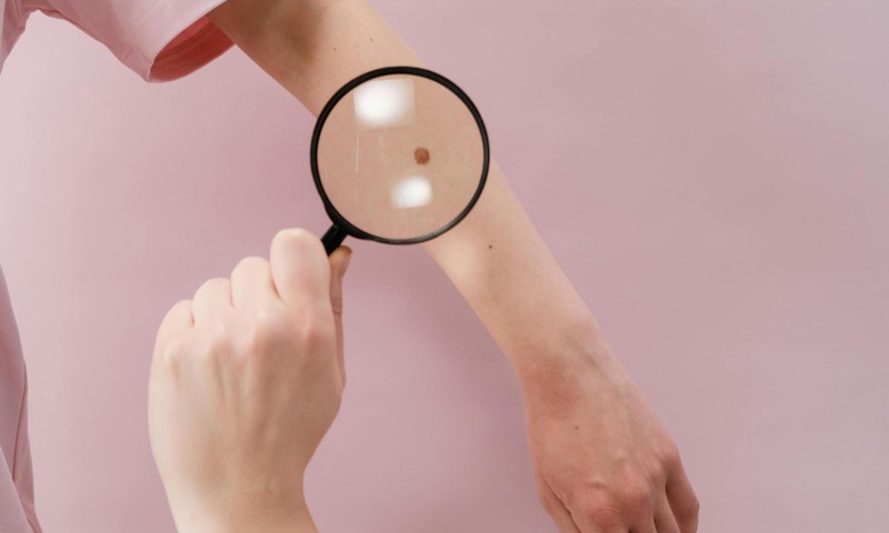 Ādas vēzis: pazīmes, profilakse un ārstēšana – dermatologa padomi