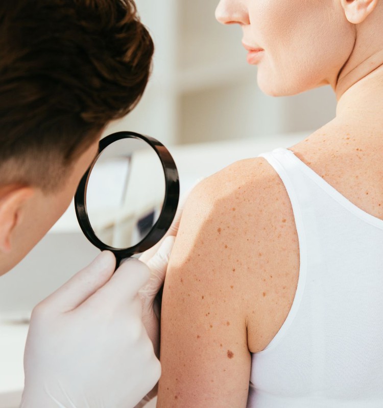 Melanoma – kā sevi pasargāt?