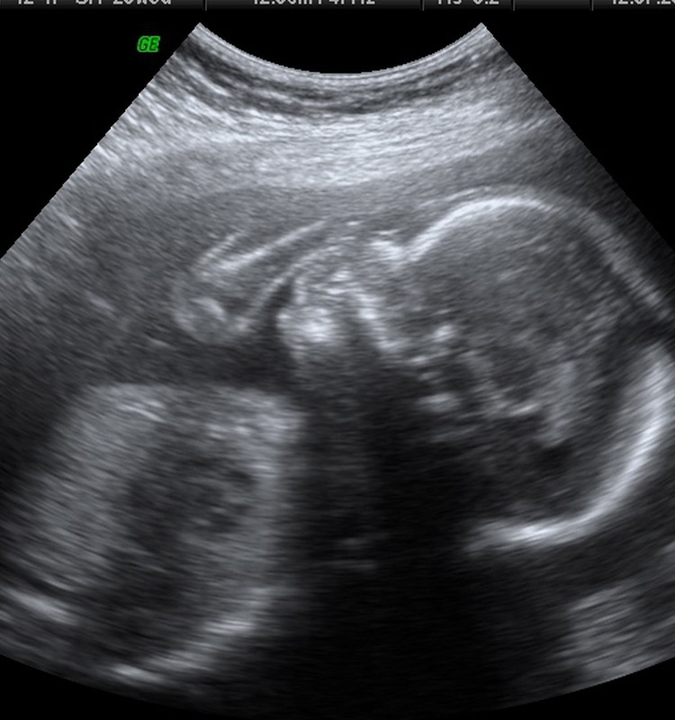 Pirms dzemdībām nepārbauda grūtnieci USG