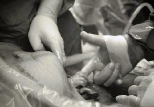 Unikāls foto: mazulis dzimstot satver ārsta pirkstu