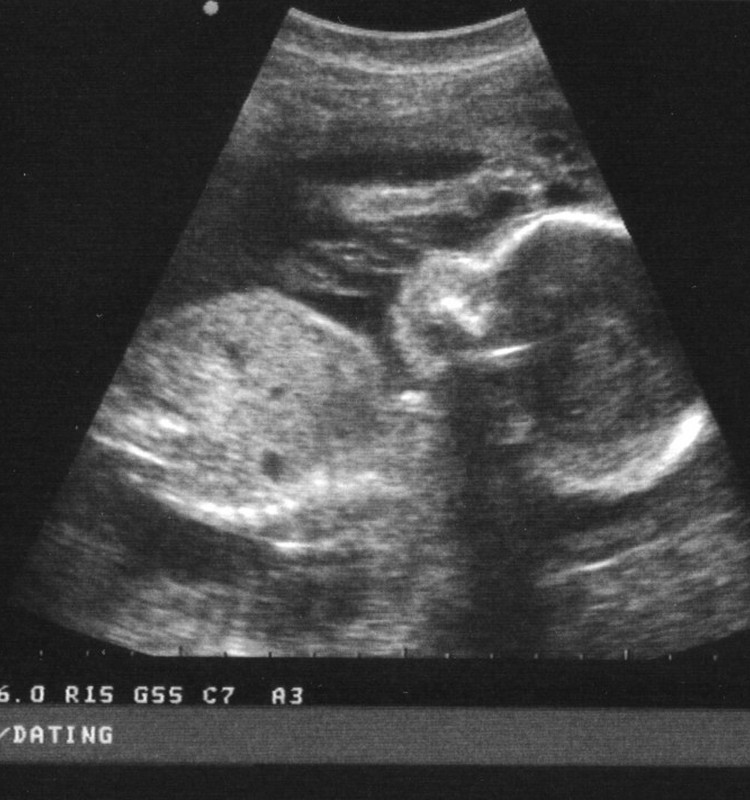 Cik bieži grūtniecības laikā jāveic USG?