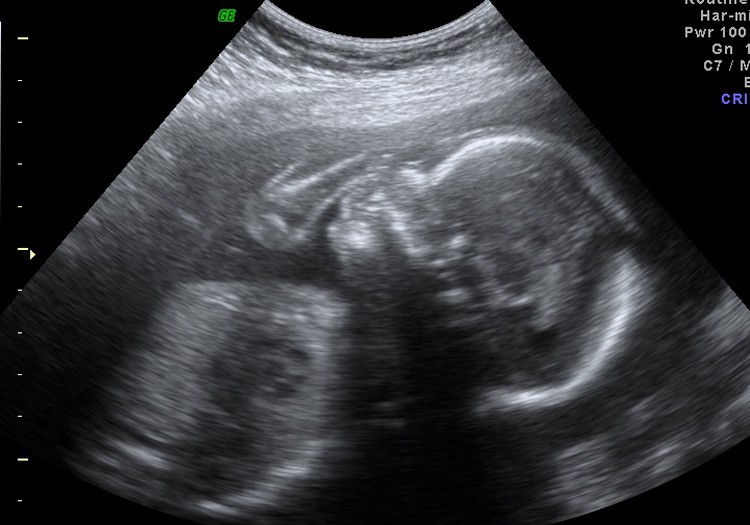 Pirms dzemdībām nepārbauda grūtnieci USG