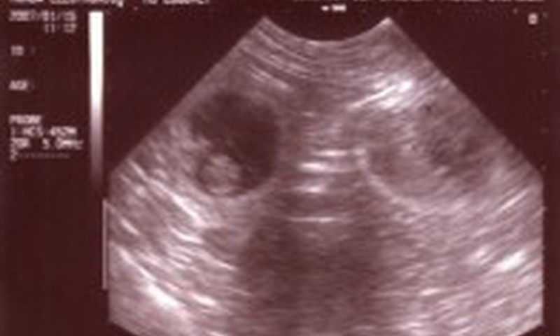 Izdarīt abortu? Pirms tam paklausies mazuļa sirdspukstus!